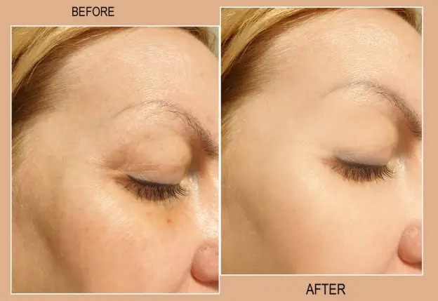 cosmetic laser treatment