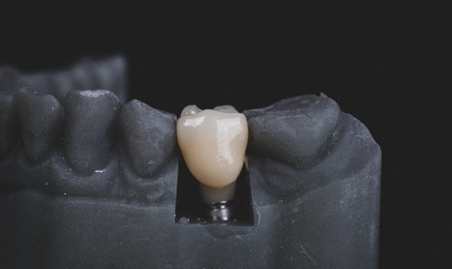 6 Amazing Benefits of Dental Implants for Older People