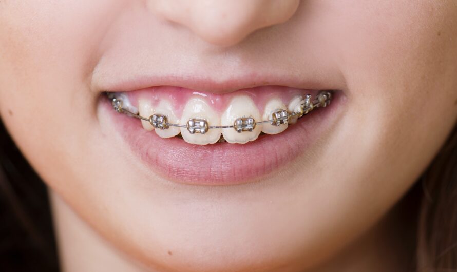 Is Invisalign Worth the Investment? Cost vs. Benefits