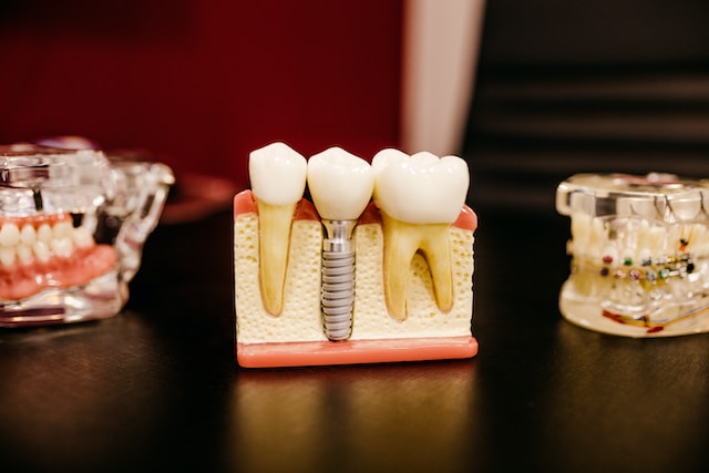 Dental Implants Guide